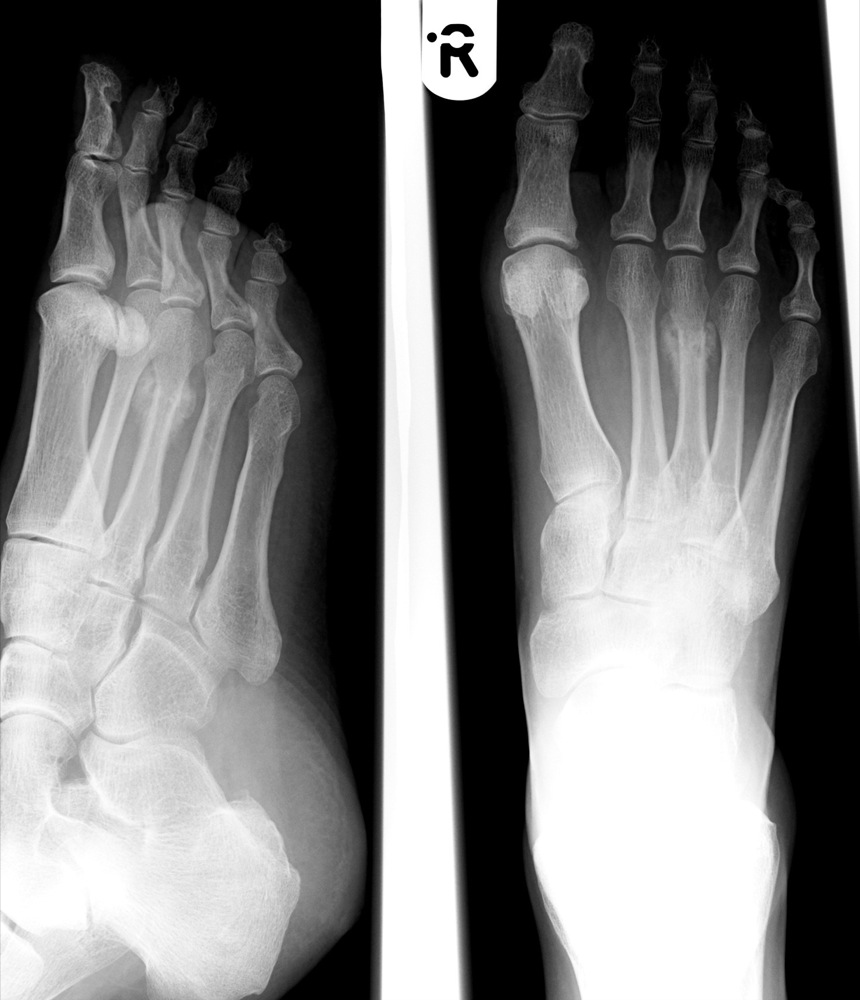 Трещина кости на ноге. Перелом лодыжки рентген. Эпифизеолиз плюсневой кости. Подагра рентген плюсневая кость.
